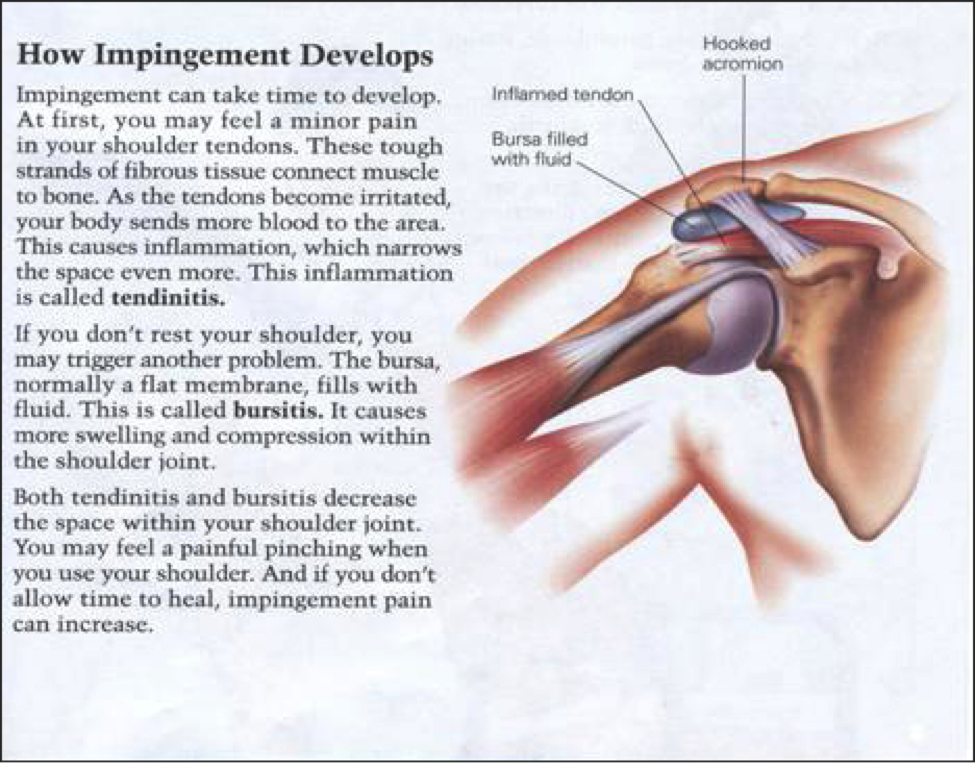 What Causes Subacromial Impingement Syndrome