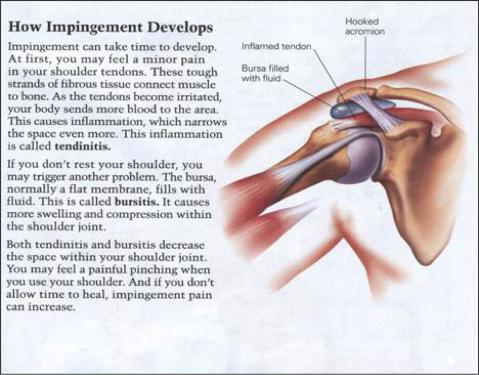 Shoulder impingement clearance symptoms