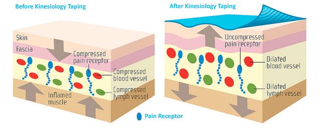 What is the difference between Kinesio®tape and athletic tape? - Physical  Therapy Portland