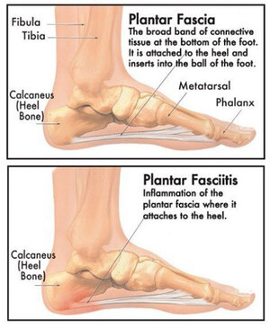 What is Plantar Fasciitis? - Pivotal Physio