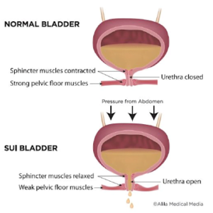 Stress Urinary Incontinence? Pelvic Floor Physiotherapy can Help ...